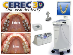 cerec-before-and-after.jpg-e1549834893579
